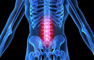 Osteochondrosis an spine lumbar