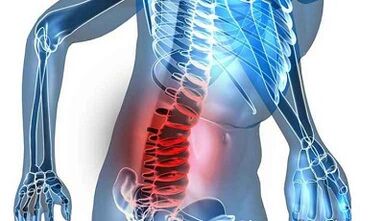 Comharthaí agus comharthaí osteochondrosis lumbar