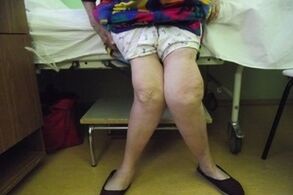 arthrosis chun cinn an comhpháirteach glúine